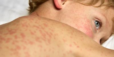 Jakie choroby zakaźne u dzieci przebiegają z wysypką?