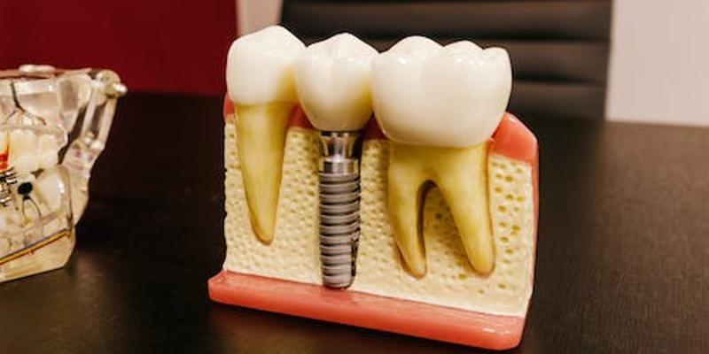 Wszczepienie implantu zęba - Jak wygląda i ile trwa zabieg?