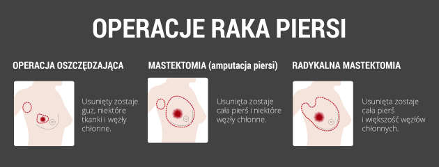 infografika - operacje raka piersi