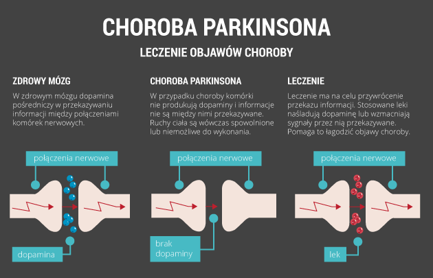 infografika - choroba Parkinsona